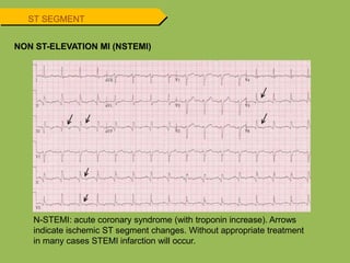 ST SEGMENT
NON ST-ELEVATION MI (NSTEMI)
N-STEMI: acute coronary syndrome (with troponin increase). Arrows
indicate ischemic ST segment changes. Without appropriate treatment
in many cases STEMI infarction will occur.
 
