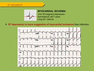 MYOCARDIAL ISCHEMIA
1mm ST-segment depression
Symmetrical, tall T wave
Long QT- interval
A ST depression is more suggestive of myocardial ischaemia than infarction
ST SEGMENT
 