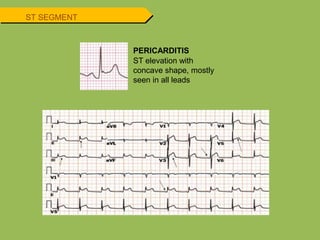 ST SEGMENT
PERICARDITIS
ST elevation with
concave shape, mostly
seen in all leads
 
