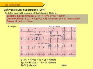 ST SEGMENT
Left ventricular hypertrophy (LVH)
To determine LVH, use one of the following Criteria:
Example:
Sokolow & Lyon Criteria: S (V1) + R(V5 or V6) > 35mm
Cornell Criteria: S (V3) + R (aVL) > 28 mm (men) or > 20 mm (women)
Others: R (aVL) > 13mm
S (V1) + R(V5) = 15 + 25 = 40mm
S(V3) + R (aVL)= 15 + 14 =29mm
R(aVL) =14 mm LVH!
 