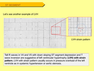 Tall R waves in V4 and V5 with down sloping ST segment depression and T
wave inversion are suggestive of left ventricular hypertrophy (LVH) with strain
pattern. LVH with strain pattern usually occurs in pressure overload of the left
ventricle as in systemic hypertension or aortic stenosis.
Let’s see another example of LVH
LVH strain pattern
ST SEGMENT
 