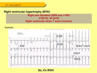 ST SEGMENT
Right ventricular hypertrophy (RVH)
Example:
Right axis deviation (QRS axis >100o)
V1(R>S), V6 (S>R)
Right ventricular strain T wave inversion
So, it’s RVH!
 