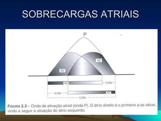 SOBRECARGAS ATRIAIS
 