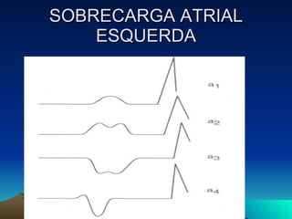 SOBRECARGA ATRIAL
    ESQUERDA
 