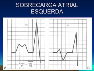 SOBRECARGA ATRIAL
    ESQUERDA
 