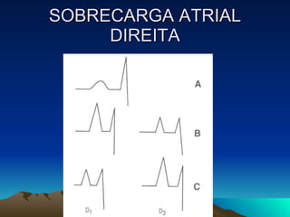 SOBRECARGA ATRIAL
     DIREITA
 