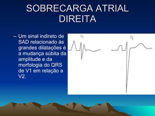 SOBRECARGA ATRIAL
          DIREITA
– Um sinal indireto de
  SAD relacionado às
  grandes dilatações é
  a mudança súbita da
  amplitude e da
  morfologia do QRS
  de V1 em relação a
  V2.
 