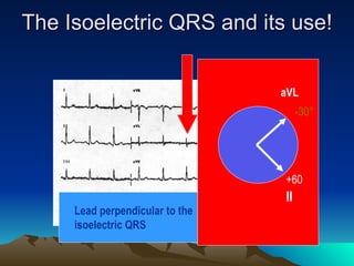 The Isoelectric QRS and its use!


                                 aVL
                                      -30°




                                 +60
                                 II
     Lead perpendicular to the
     isoelectric QRS
 