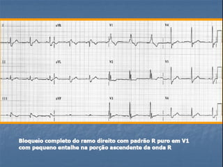 Ecg 5.0