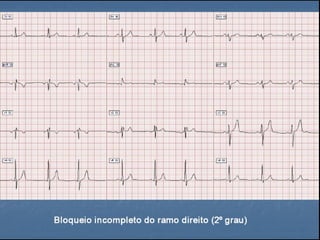 Ecg 5.0