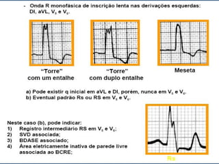 Ecg 5.0