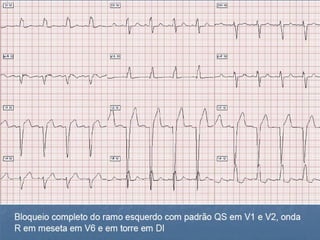 Ecg 5.0