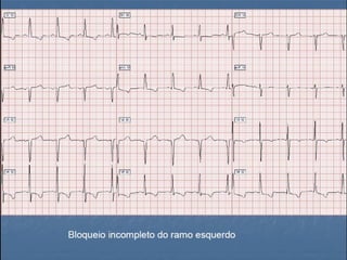 Ecg 5.0