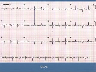 Ecg 5.0
