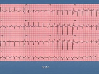 Ecg 5.0