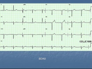 Ecg 5.0