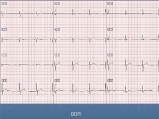 Ecg 5.0