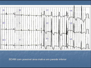 Ecg 5.0