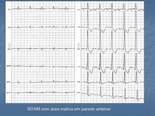 Ecg 5.0