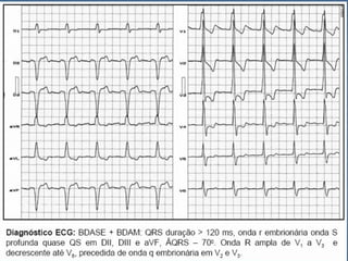 Ecg 5.0