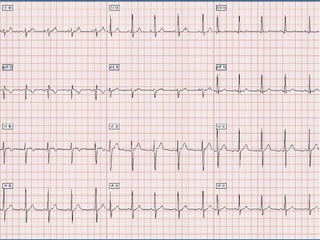 Ecg 5.0