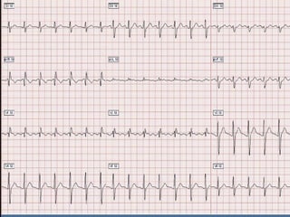 Ecg 5.0