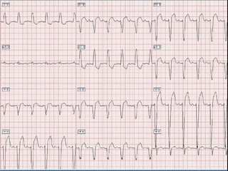 Ecg 5.0