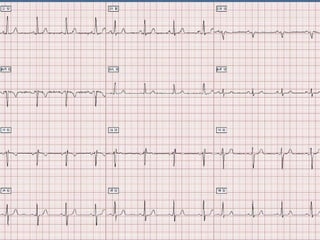 Ecg 5.0