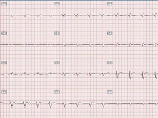 Ecg 5.0