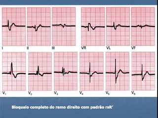 Ecg 5.0