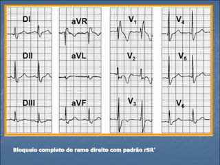 Ecg 5.0