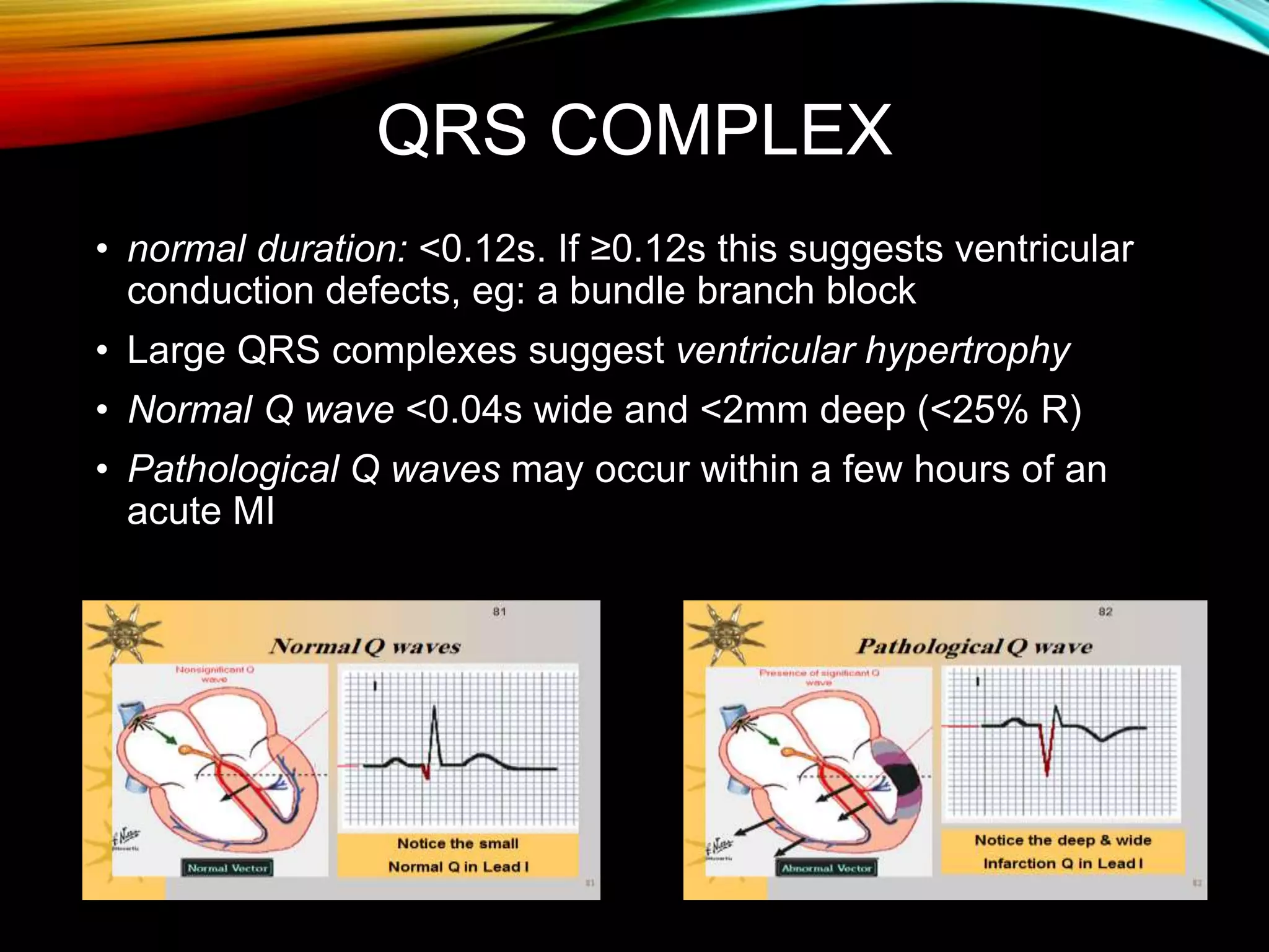 QRS COMPLEX
• normal duration: <0.12s. If ≥0.12s this suggests ventricular
conduction defects, eg: a bundle branch block
• Large QRS complexes suggest ventricular hypertrophy
• Normal Q wave <0.04s wide and <2mm deep (<25% R)
• Pathological Q waves may occur within a few hours of an
acute MI
 