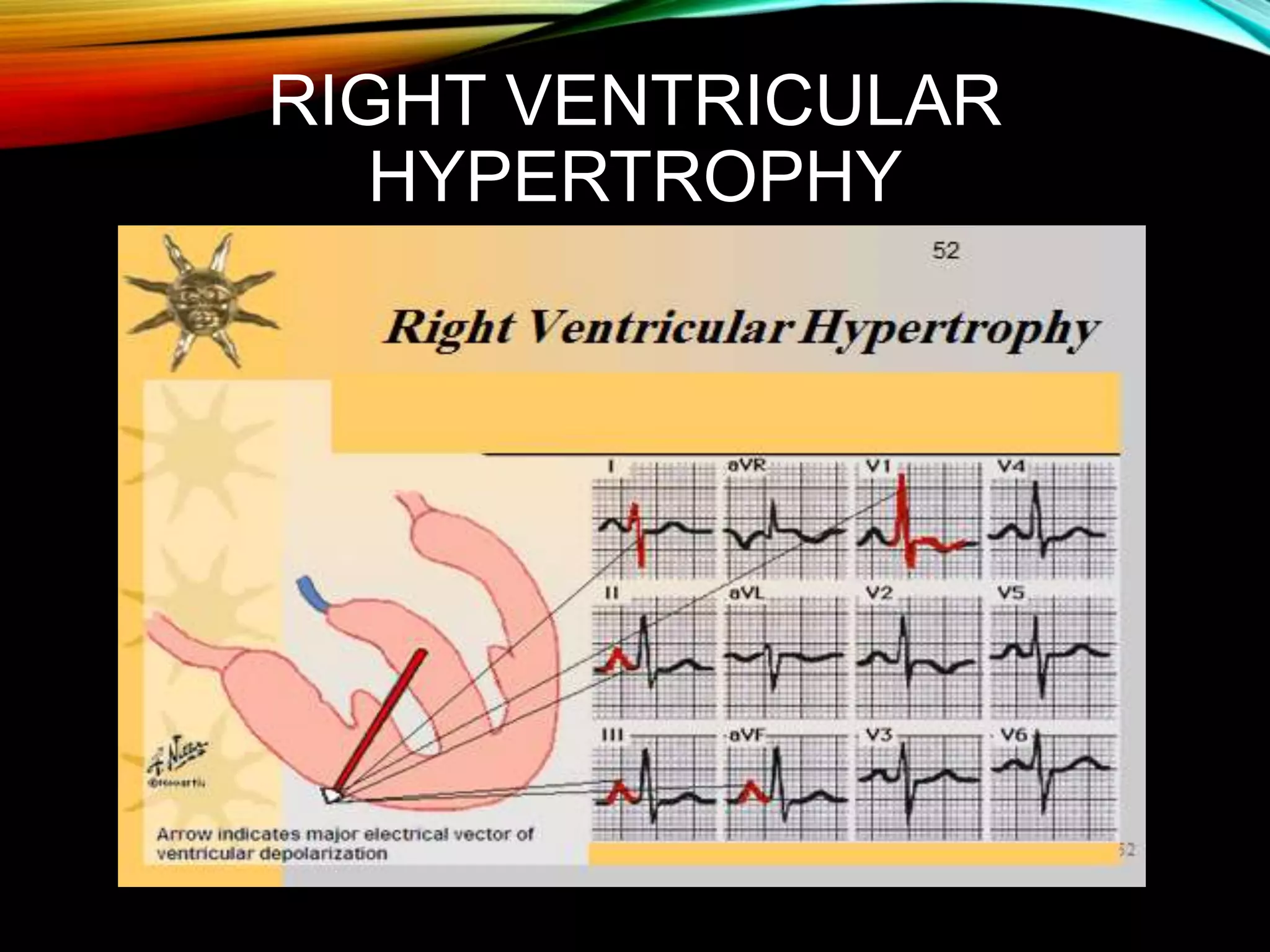 RIGHT VENTRICULAR
HYPERTROPHY
 