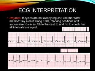 ECG INTERPRETATION
• Rhythm: If cycles are not clearly regular, use the ‘card
method’: lay a card along ECG, marking positions of 3
successive R waves. Slide the card to and fro to check that
all intervals are equal.
 