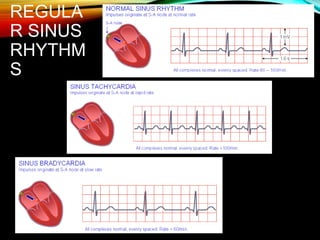 REGULA
R SINUS
RHYTHM
S
 