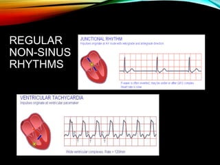 REGULAR
NON-SINUS
RHYTHMS
 
