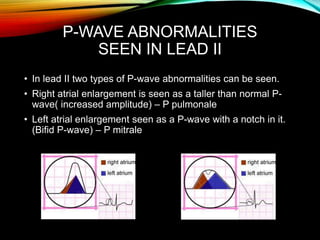 P-WAVE ABNORMALITIES
SEEN IN LEAD II
• In lead II two types of P-wave abnormalities can be seen.
• Right atrial enlargement is seen as a taller than normal P-
wave( increased amplitude) – P pulmonale
• Left atrial enlargement seen as a P-wave with a notch in it.
(Bifid P-wave) – P mitrale
 
