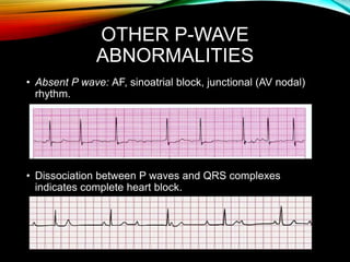 OTHER P-WAVE
ABNORMALITIES
• Absent P wave: AF, sinoatrial block, junctional (AV nodal)
rhythm.
• Dissociation between P waves and QRS complexes
indicates complete heart block.
 