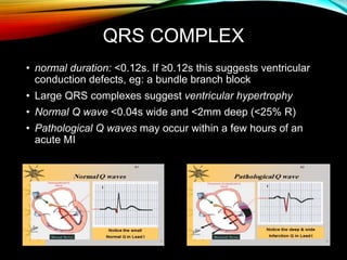 QRS COMPLEX
• normal duration: <0.12s. If ≥0.12s this suggests ventricular
conduction defects, eg: a bundle branch block
• Large QRS complexes suggest ventricular hypertrophy
• Normal Q wave <0.04s wide and <2mm deep (<25% R)
• Pathological Q waves may occur within a few hours of an
acute MI
 