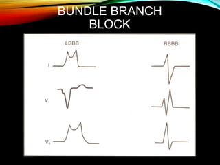 BUNDLE BRANCH
BLOCK
 