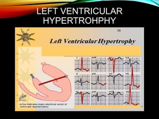 LEFT VENTRICULAR
HYPERTROHPHY
 