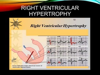 RIGHT VENTRICULAR
HYPERTROPHY
 