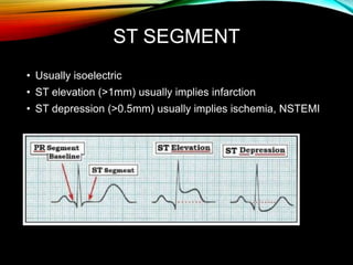 ST SEGMENT
• Usually isoelectric
• ST elevation (>1mm) usually implies infarction
• ST depression (>0.5mm) usually implies ischemia, NSTEMI
 