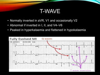 T-WAVE
• Normally inverted in aVR, V1 and occasionally V2
• Abnormal if inverted in I, II, and V4–V6
• Peaked in hyperkalaemia and flattened in hypokalaemia
 