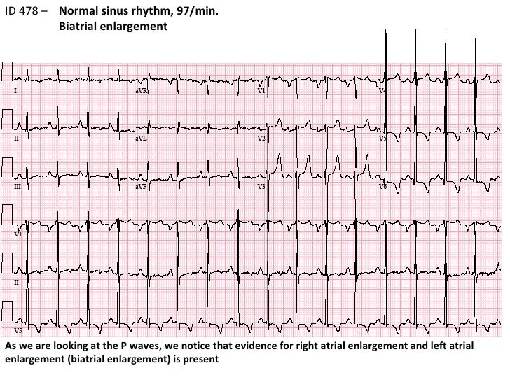 ECG 8 ID478 LVH BAE