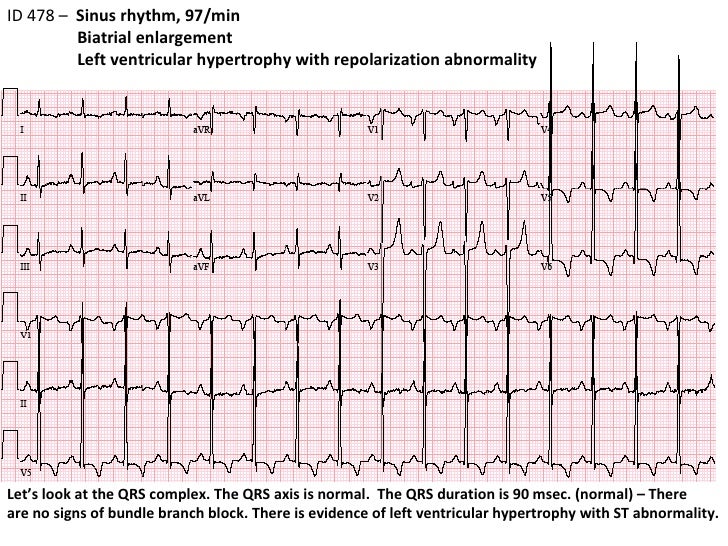 ECG 8 ID478 LVH BAE