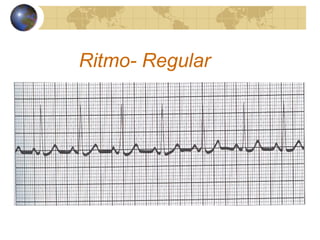 Ritmo- Regular
 