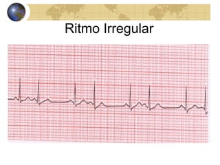 Ritmo Irregular
 