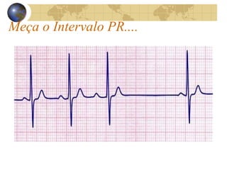 Meça o Intervalo PR....
 