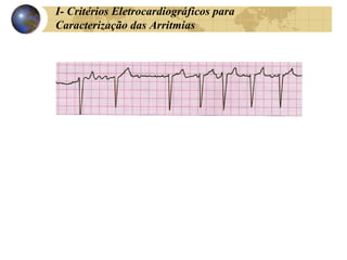 I- Critérios Eletrocardiográficos para
Caracterização das Arritmias
 